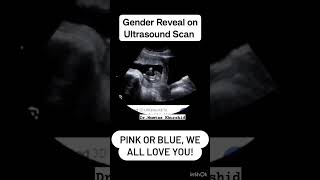 Baby Gender on Ultrasound Scan [upl. by Croner]