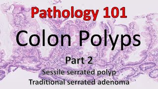 Colon Polyps  Part 2  Pathology 101 [upl. by Nylekoorb433]