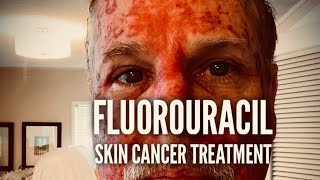 Fluorouracil Skin Treatment  Before During and After [upl. by Nottus]