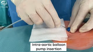 Intraaortic balloon pump insertion [upl. by Herwick837]