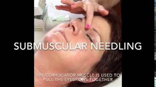 Michelle Gellis teaches acupuncture needling of corrugator muscle for facial cosmetic acupuncture [upl. by Obie]