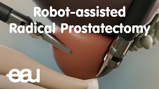 Robotassisted Radical Prostatectomy RARP [upl. by Elyad]