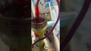 Plasmapheresis  YouTube viralshorts video [upl. by Ellenehc]