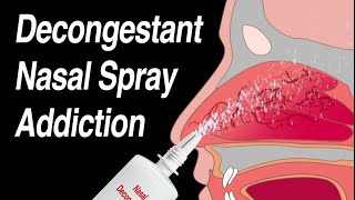 Decongestant Nasal Spray Addiction Afrin Zicam Sinex NeoSynephrine etc [upl. by Elocen]