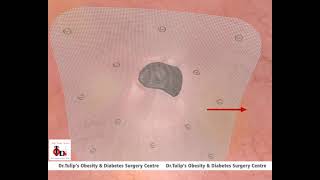 Umbilical Hernia Repair  Animation  Dr Tulips TODS  Animation of Repair of Umbilical hernia [upl. by Disharoon]