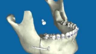 Retroceso de Mandíbula por Prognatismo Mandibular [upl. by Carol]