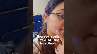 Acne prone skin treatment 🥹🔥 acnetreatment acneproneskin isotretinoin acnecare trending [upl. by Aicilf191]