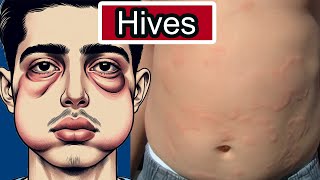 Hives Urticaria Explained Allergies Triggers and Relief Strategies [upl. by Rhee993]