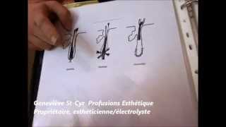 électrolyse epilation par la thermolyse explication [upl. by Calendre118]