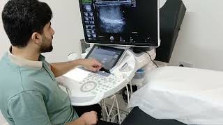 Scrotal Ultrasound  Hydrocele  microlithiasis [upl. by Anaeli]