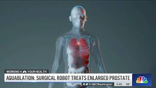 News4 at 4  Aquablation Surgical Robot Treats Enlarged Prostate [upl. by Loy]