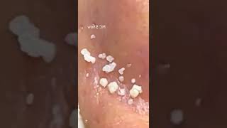 Pickel Ausdrücken Blackheads Akne amp Mitesser entfernen 🔴 28 [upl. by Elleunamme]