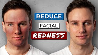 How to GET RID OF REDNESS on your FACE [upl. by Marten]