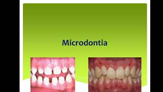 37Management of Microdontia [upl. by Nner]