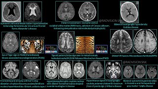 Pediatric Neuroradiology Rare but classic cases RBC set III [upl. by Bourke]