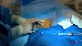 Live Webcast Cardiac Catheterization Angioplasty amp Stent [upl. by Eniamor766]