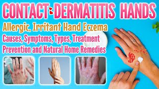 Contact dermatitis hands types causes symptoms treatment home remedy  eczema on hands [upl. by Ezar933]