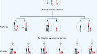 ROBERTSONIAN TRANSLOCATION FAMILIAL DOWN SYNDROME [upl. by Aniara]