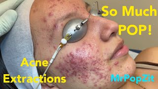 So much pop Acne extractions on severe inflammatory acne Multiple blackheads and whiteheads [upl. by Danika]