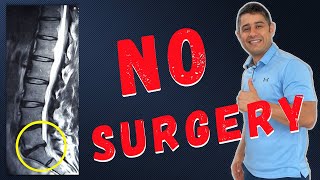 Lumbar Disc Bulges L5 S1 recovery without surgery [upl. by Zsamot245]