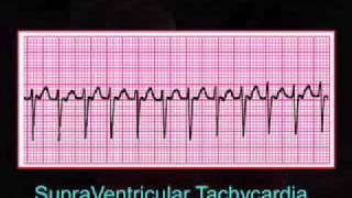 Introduction to EKG Rhythm Interpretation Part 3 [upl. by Anigger]