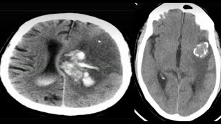 CNSSpotters 16 case Radiology neuroradiology radiological radiopedia frcr medicalimaging [upl. by Gulgee]