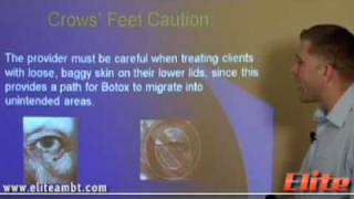 Botox Crows Feet Caution  Private Botox Training  Elite AMBT [upl. by Olympie303]