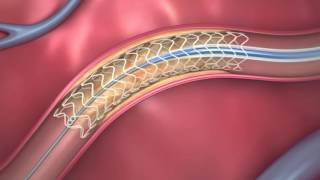 FDAApproved Dissolving Heart Stent  How It Works [upl. by Atazroglam]