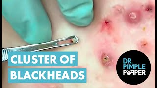 50 Minutes of Blackheads Clusters of Blackheads with Dr Pimple Popper [upl. by Sotsirhc]