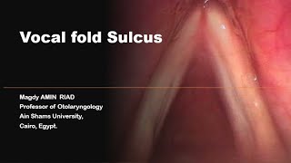 Vocal folds Sulcus [upl. by Adliw]