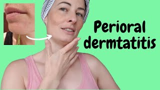 Perioral Dermatitis treatment naturally  Amperna  video 2 [upl. by Charis]