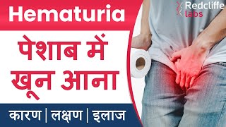 ⛔Hematuria पेशाब में खून आना  Symptoms And Causes in Hindi  ✅ Hematuria Blood in Urine का इलाज [upl. by Enileve]