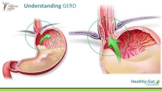 H pylori Infections Acid Reflux and Peptic Ulcers [upl. by Hernardo]