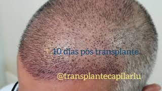 Resultado real transplante capilar FUE após 10 dias grau V gigasessão cabelo grisalho Dr Paulo Lu [upl. by Monda]