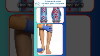 Varicose Vein Removal Phlebectomy Procedure By Best Vascular Surgeon telugu VaricoseVeins shorts [upl. by Abshier]