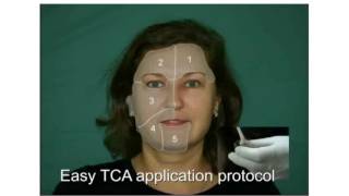 Skin Tech guide for patients Easy TCA treatment [upl. by Perpetua767]