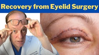 How to Recover from a Blepharoplasty  Plastic Surgeons Guidance on Eyelid Surgery Recovery [upl. by Esyla]