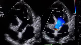 RWMAModerate LV DysfunctionTrace pericardial effusionpleural effusion cardioheartcondition [upl. by Anivlac771]