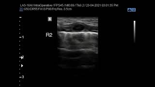 2B lines in TTN transient tachypnea of newborn [upl. by Akvir480]