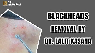 Blackhead removal Dr Lalit kasana  blackhead removal on face This week 2022 [upl. by Emoreg290]