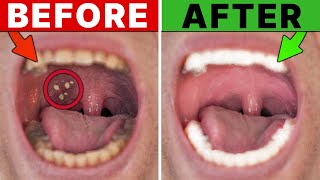 CURE Tonsil Stones  NEVER Get Tonsil Stones Again [upl. by Enaamuj424]