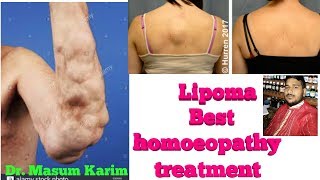 Lipoma homeopathy best medicine how to treatment lipoma without surgery [upl. by Dorrie818]