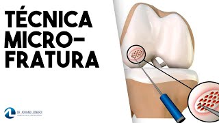 LESÃO CARTILAGINOSA Tratamento através da técnica da MICROFRATURA [upl. by Ynnor]