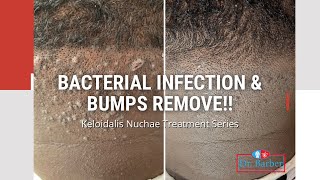 Bacteria amp Bumps Removed [upl. by Aleinad]