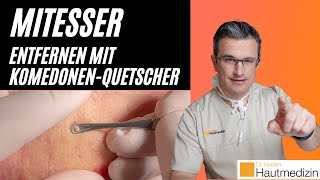 Mitesser entfernen mit Komedonenquetscher Wie geht das  Dr Kasten Hautmedizin in Mainz mitesser [upl. by Bohner37]