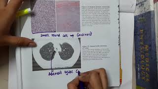 Adenoid Cystic Carcinoma mp4 [upl. by Medeah]