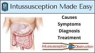 Intussusception Causes Symptoms Diagnosis Treatment Nursing USMLE [upl. by Christos]