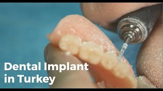 Dental Implant in Turkey Full Mouth Dental Implant Cost in Turkey LyfboatMedicare [upl. by Anelehs]