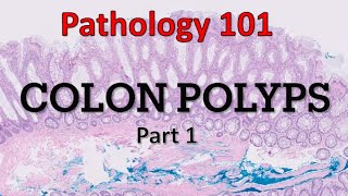 Colon Polyps  Part 1 Pathology 101 [upl. by Brockwell]