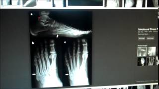 5th Metatarsal Fractures [upl. by Vander]